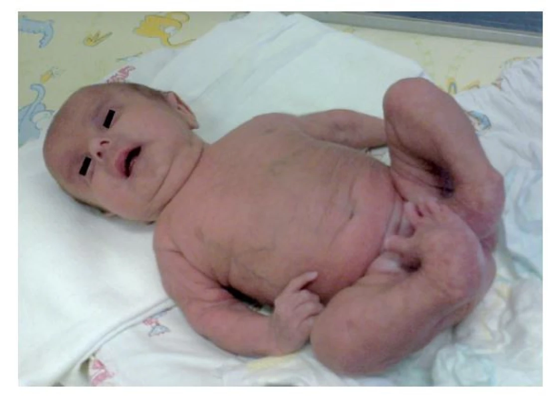 Fenotyp v novorodeneckom veku. Pozorovaná bola progeroidná
facies, voľná suchá tenká koža s presvitajúcou cievnou
kresbou, vrodená vývojová chyba dolných končatín.
