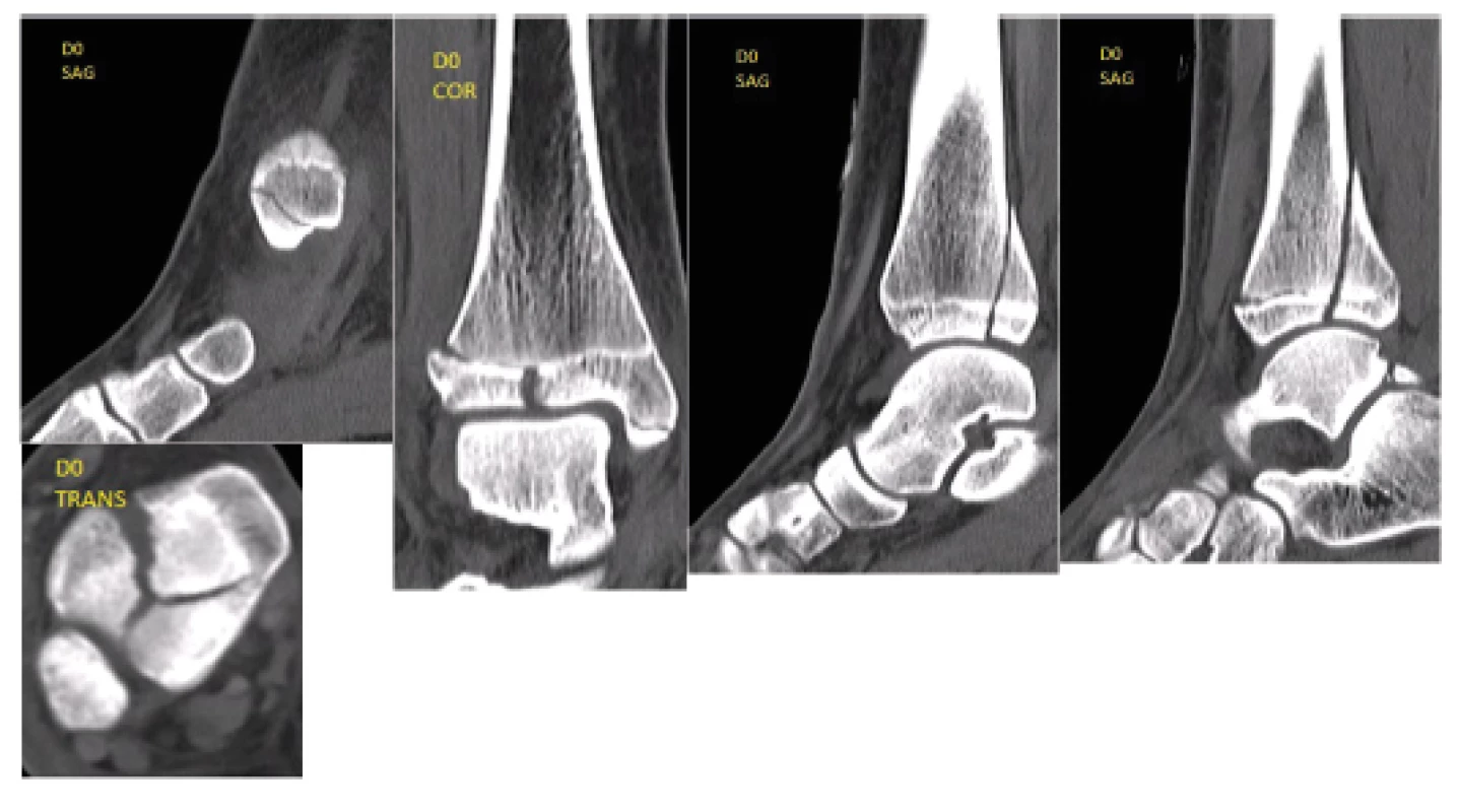 HRCT examination of the malleolus was performed at our department; based upon the findings, we determined the diagnosis of triplane four-fragment fracture
