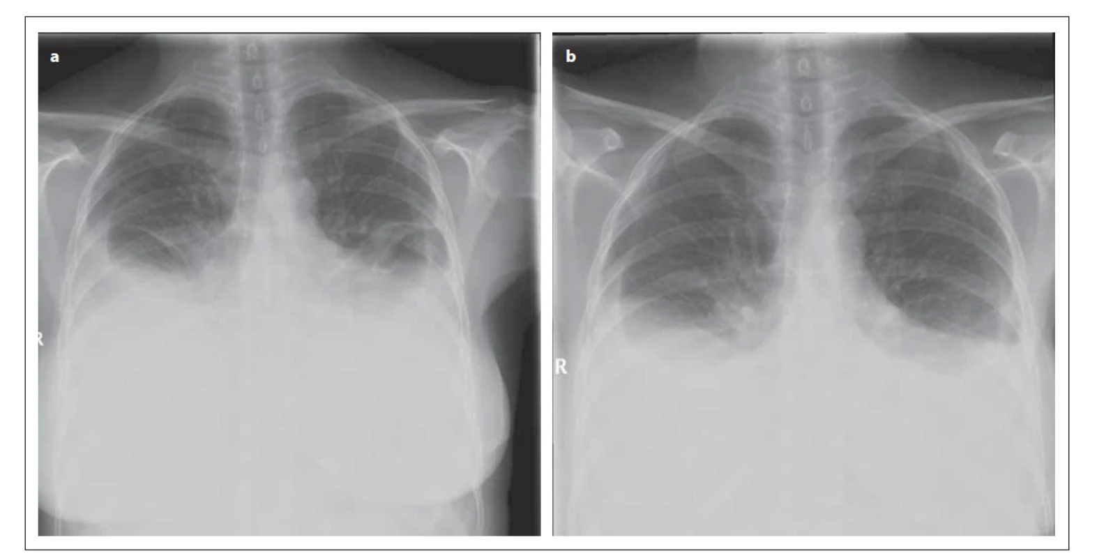 Rentgenový snímek hrudníku pacientky (a) 9. 2. 2012 (předozadní projekce) – je patný oboustranný fl uidothorax
ventrálně po 3. žebro; srdeční stín je nehodnotitelný; mediastinum není rozšířeno. (b) 15. 2. 2012 (předozadní
projekce) – je patrná regrese oboustranného fl uidothoraxu, dosahuje ventrálně po 4. žebro; srdeční stín není
hodnotitelný; mediastinum není rozšířeno.