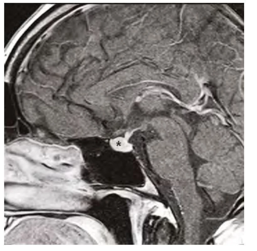 Kontrolní magnetická rezonance mozku ve sagitálním řezu v postkontrastním
T1-váženém obraze, hvězdička označuje zmenšenou hypofýzu
po 12 měsících substituční hormonální léčby