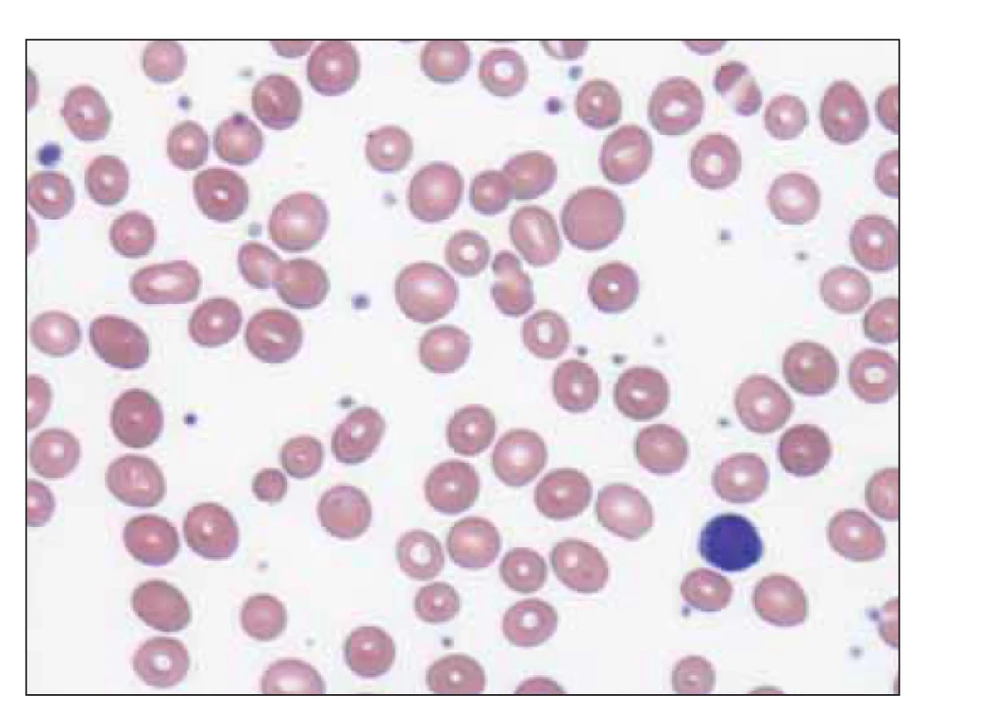Normocyty a makrocyty v nátěru periferní krve –
nemocná s akutní myeloidní leukemií (zdroj: laboratoř IV. IHK).