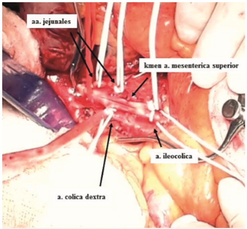 Vypreparovaný kmen a větvení a. mesenterica superior v průběhu operační embolektomie