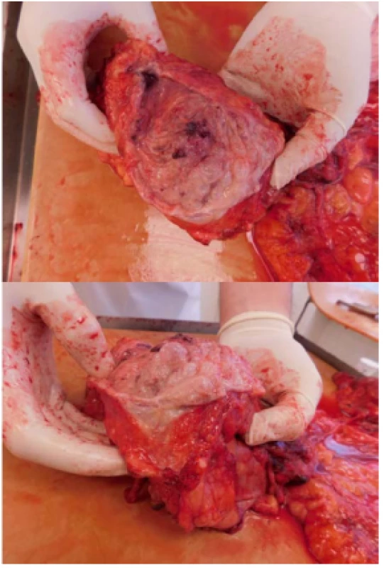 Pitevní preparát močového měchýře s plynem
pod sliznicí mechýře<br>
Fig. 3. Autopsy preparation with gas under the bladder
mucosa