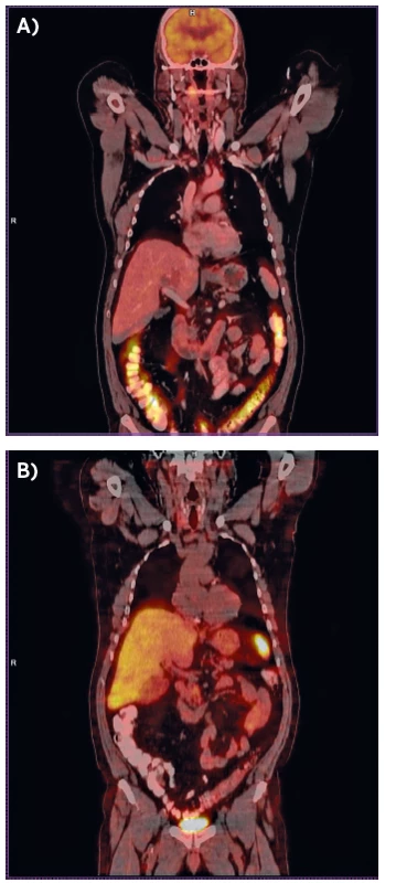 Staging ochorenia, kazuistika 2.<br>
A – PET/CT nález, B – oktreoskan