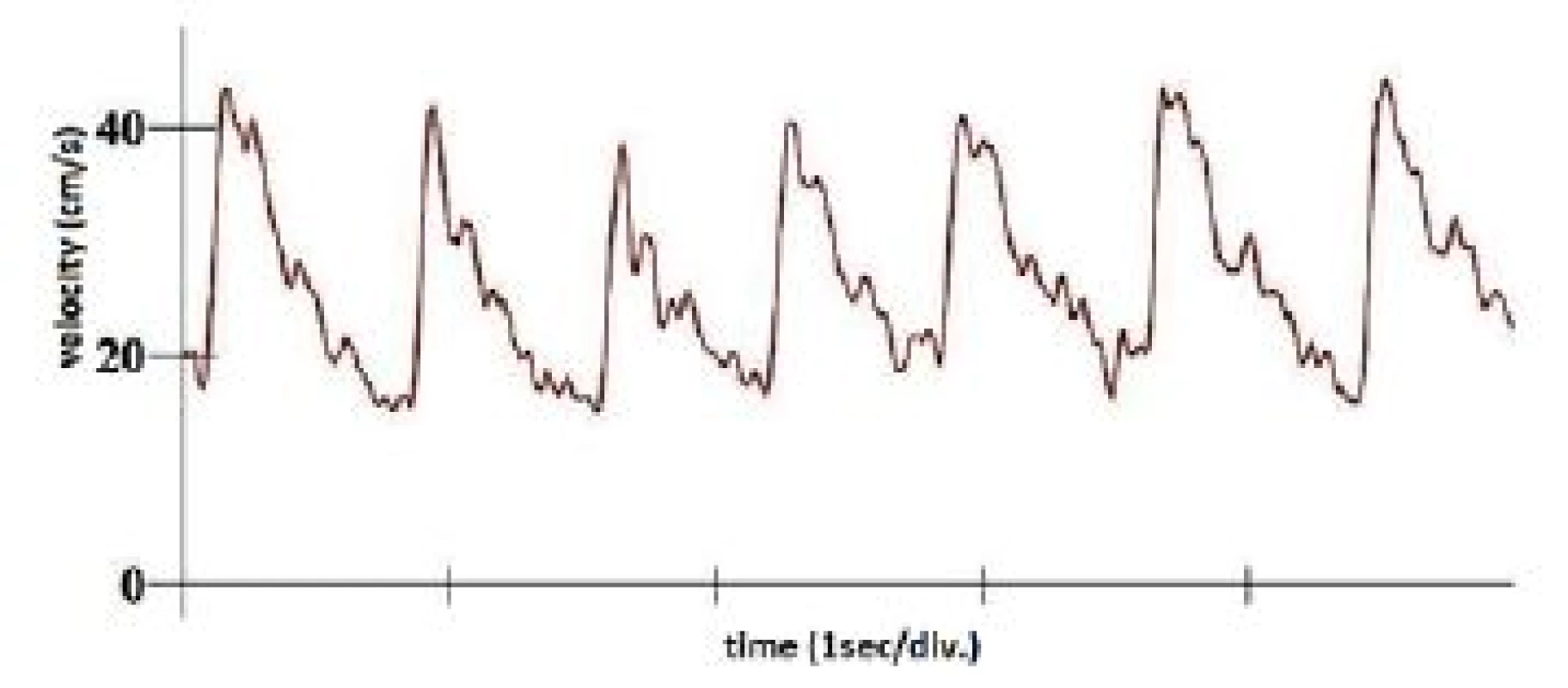 Typical appearance of after-exercise velocity waveforms.