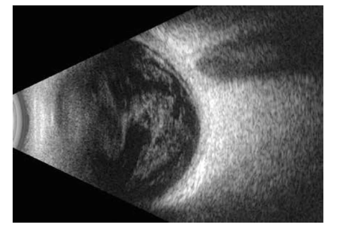 Na USG B-scane sa v sklovci zobrazujú husté líniovité a chuchvalcové
echogenity, bez prítomnosti amočnej ozvy sietnice