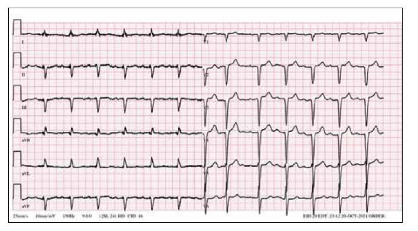 EKG nález kombinace AV blokády 1. stupně a levé přední hemiblokády u pacienta s wtATTR.