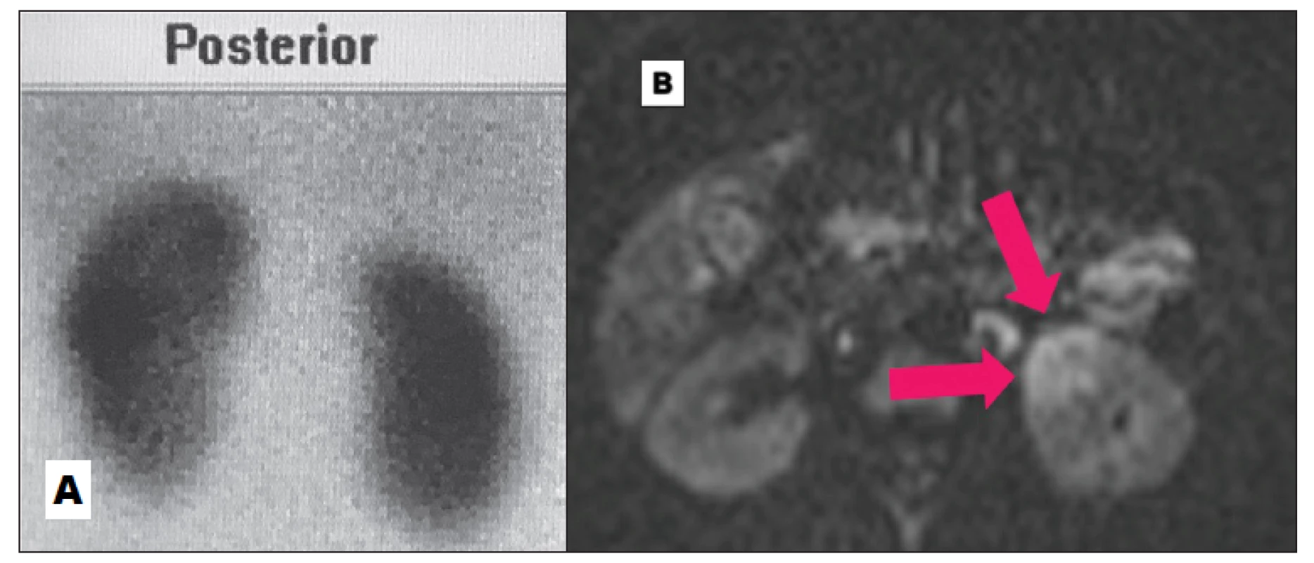 Negativní DMSA (A) a četná zánětlivá ložiska na DW-MRI (B) v akutní fázi.