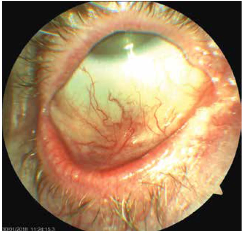 Pravé oko pacientky- jizevnatá blefarokonjunktivitida,
bělavé plaky na okrajích víček, později vzniklá
symblefara