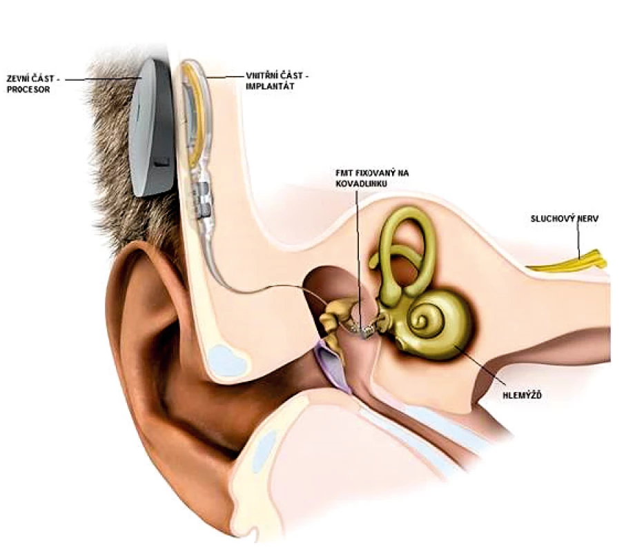Aktivní středoušní implantát. Tvoří jej zevní část obsahující procesor
a vnitřní část implantovaná pod periost za uchem. Na kovadlinku
je fixován FMT, který přenáší vibrace na středoušní kůstky.
Upraveno se svolením firmy Medel.