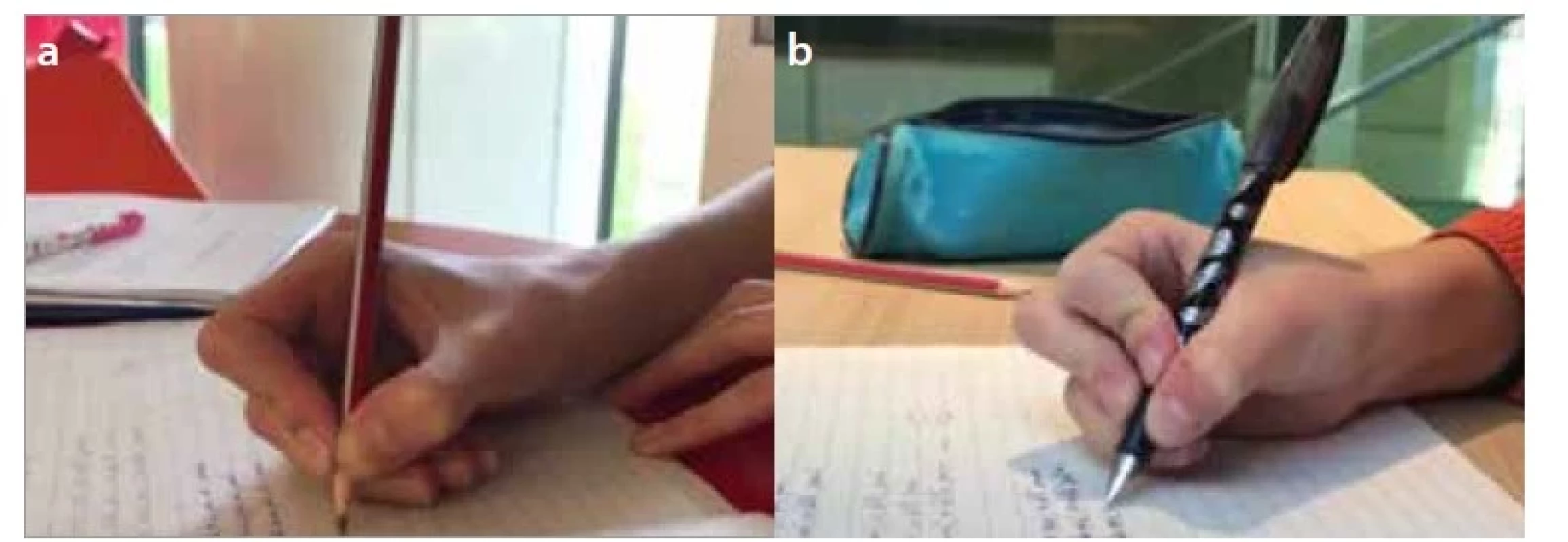a,b. Modifikovaný špetkový úchop – přitažená špetka – a) vedená třemi
prsty (tříprstá přitažená špetka), b) vedená čtyřmi prsty (čtyřprstá přitažená
špetka).<br>
Fig. 2a,b. Modified pencil grip – a) modified dynamic tripod, b) modified dynamic
quadruped grip.