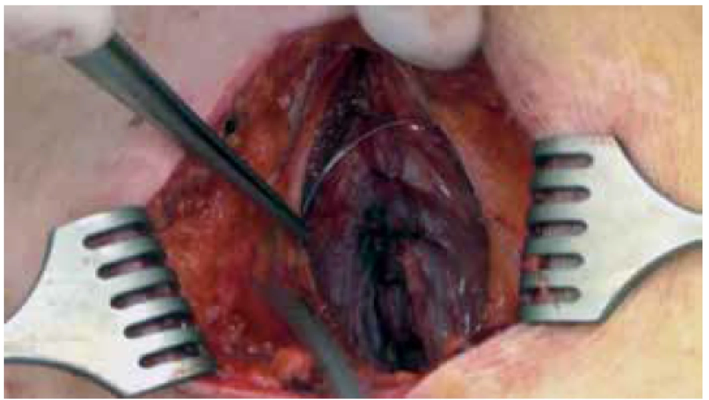 Preperitoneální uložení katétru<br>
Fig. 2. Preperitoneal catheter placement