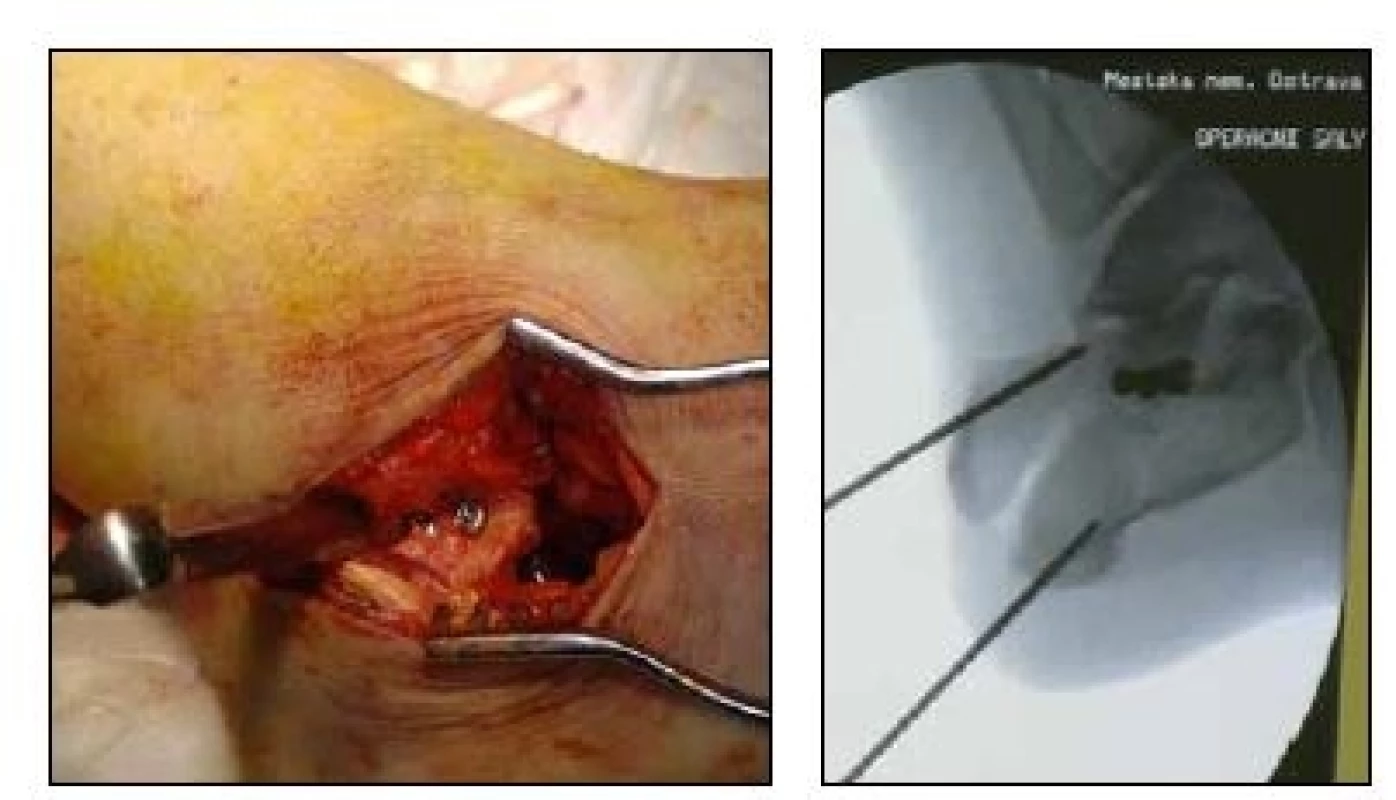 nsertion of spongious screws fixing the posterior articular surface