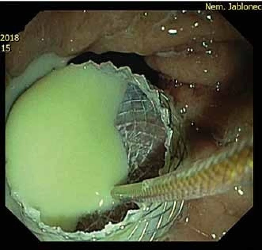 Proximální konec stentum v žaludku po drenáži abscesu.<br>
Fig. 4. A proximal flange in the stomac after abscess drainage.