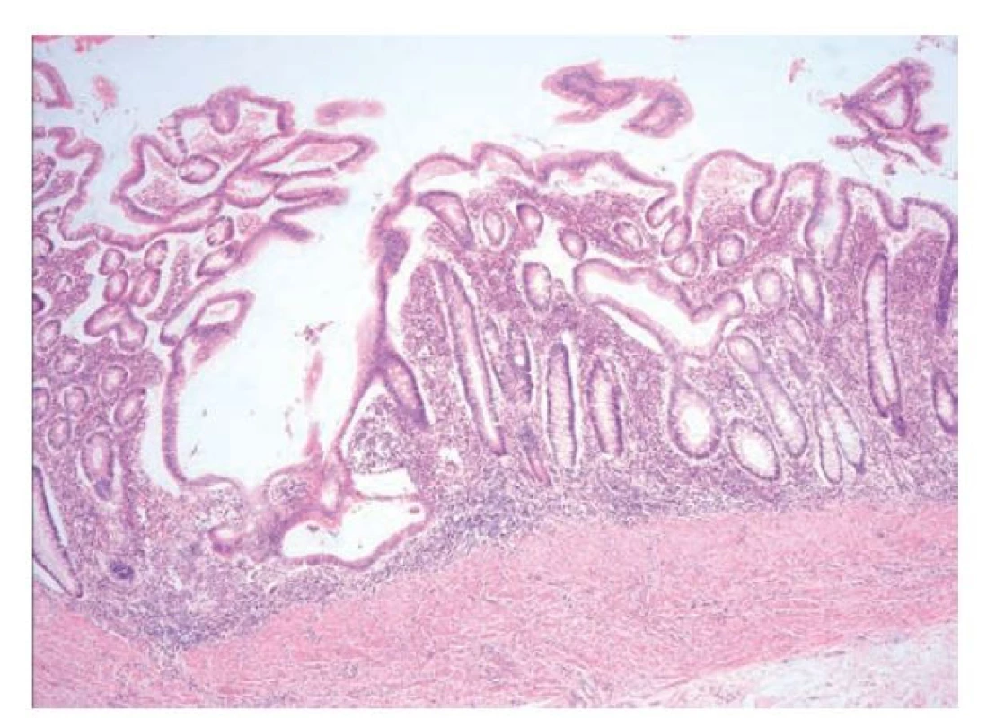 Resekát tlustého střeva u pacienta s ulcerózní kolitidou. Sliznice vykazuje
poruchu architektoniky s defigurací, větvením a dilatací krypt. V lamina
propria je intenzivní chronický aktivní zánět, který je rovnoměrně rozložený
a zůstává omezený na lamina propria. Lamina muscularis mucosae
a submukóza jsou intaktní (hematoxylin a eosin, 40x).