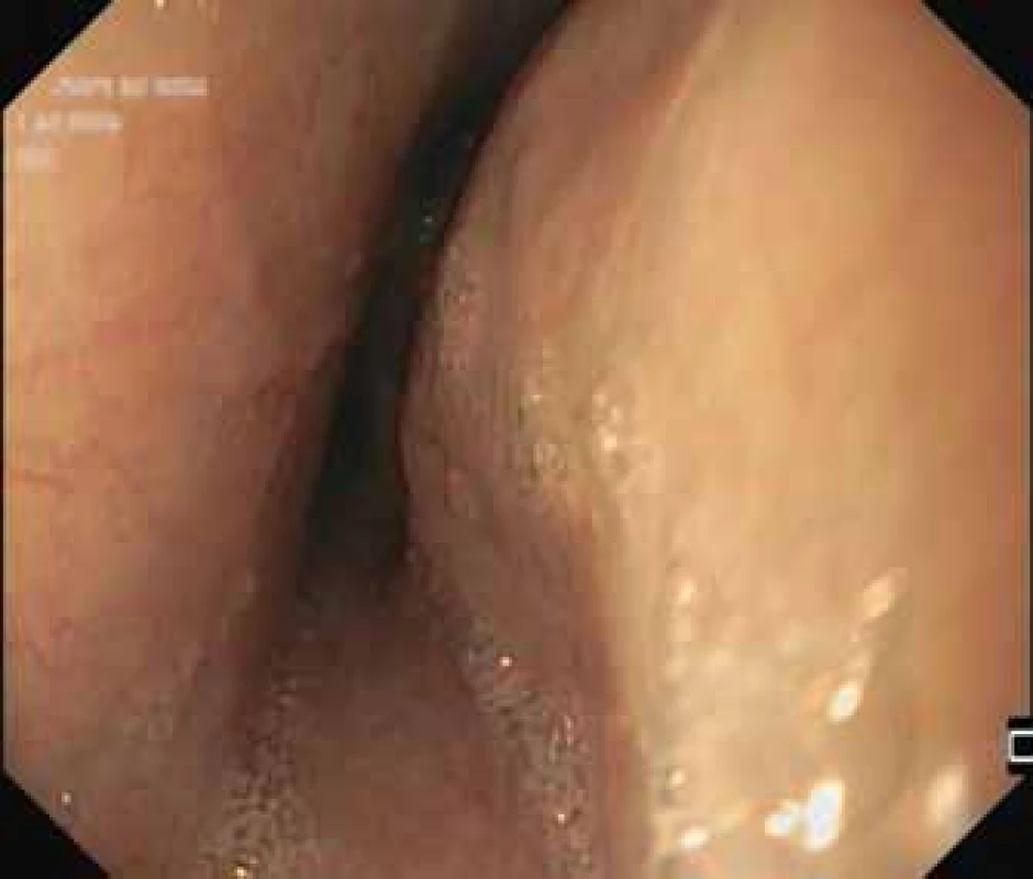 Endoskopický obraz,
extramurální stenóza středního jícnu
s normálním slizničním nálezem.<br>
Fig. 4. Endoscopic image, extramural
stenosis of middle oesophagus with
normal mucosa.