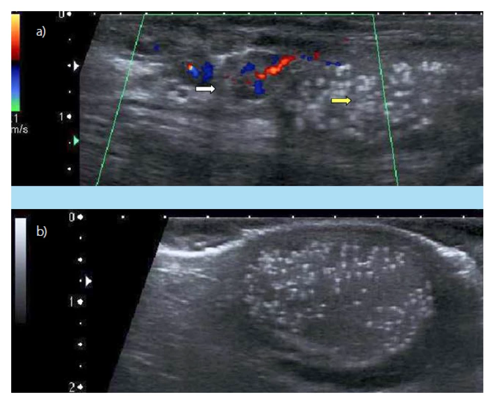 a, b. a) Dopplerovská
sonografie varlete vlevo: varikokéla
(bílá šipka), TM (žlutá šipka)
(2012, pacient č. 1); b) USG pravého
varlete s mikrolitiázou, malá
hydrokéla (2012, pacient č. 1)<br>
Fig. 2. a, b. a) Doppler ultrasound
examination of the left
testis: varicocele (white arrow),
Testicular microlithiasis (yellow
arrow) (2020, patient No 1).
b) Ultrasonound examination of
the right testis: Testicular microlithiasis,
small hydrocele) (2020,
patient No 1)
