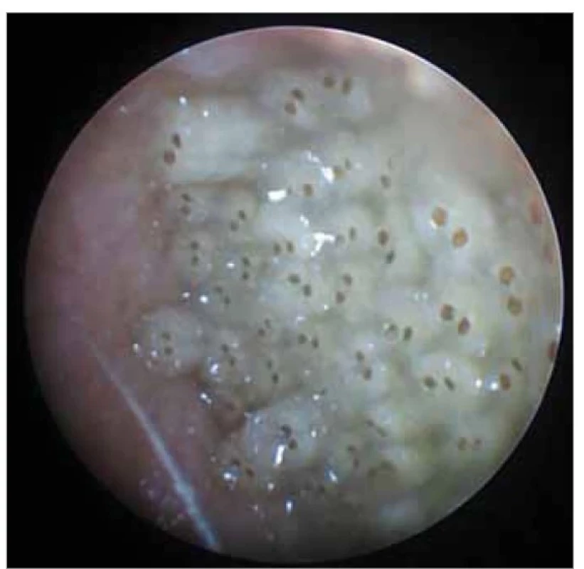 Otomikroskopický nález larev v levém zevním
zvukovodu.<br>
Fig. 2. Otomicroscopic finding of maggots in the left external
auditory canal.