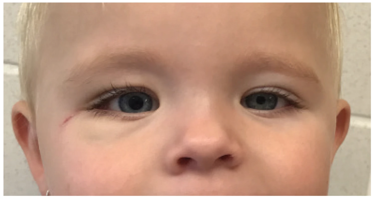 Photograph obtained six months after surgery. Persistent medium range mydriasis of the right eye and slight facial asymmetry