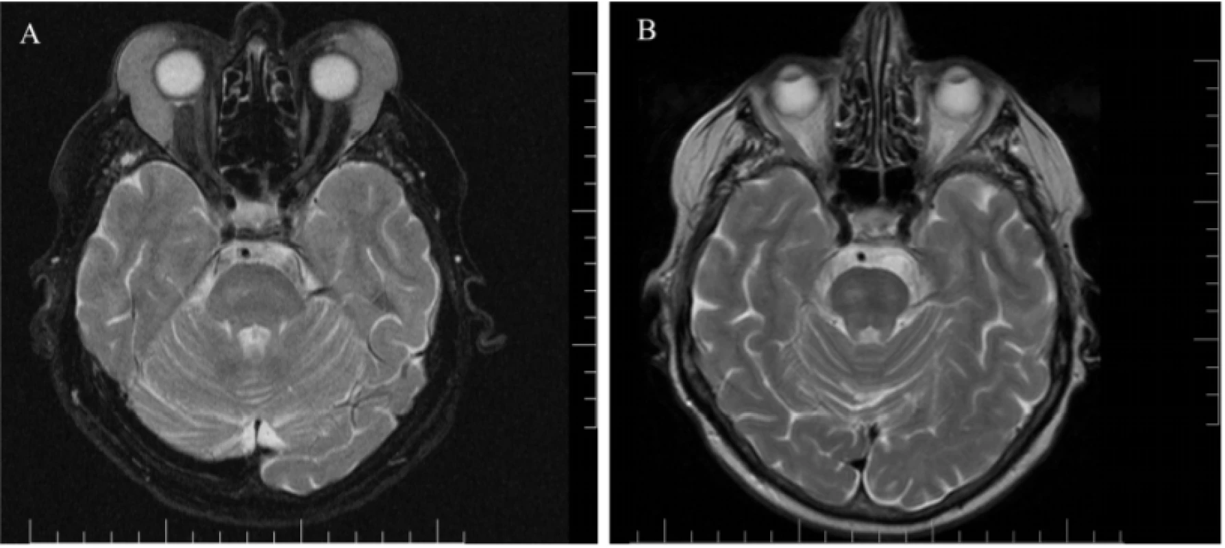 Fig. 2. Patient 1 – magnetic resonance of head: axial cross-section, T2 weighting, bilateral lymphoma
of upper eyelids<br>
A) at time of diagnosis 02/2018<br>
B) following chemotherapy and immunological treatment 01/2019