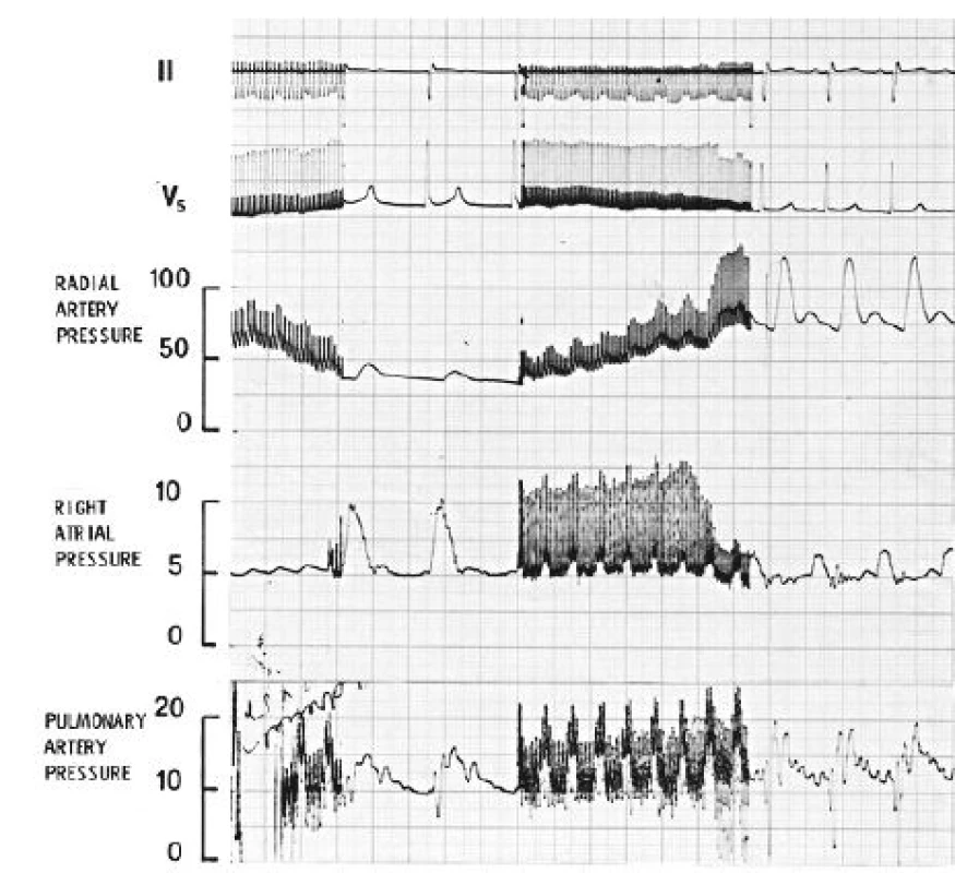 Úsek záznamu kontinuálního elektrokardiogramu (svody II a V5), tlaků v a.
radialis, pravé síni a a. pulmonalis během celkové anestezie