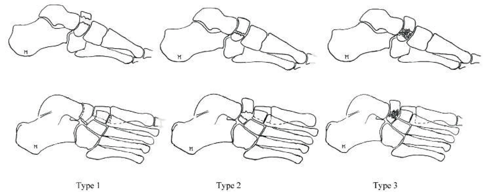 Zlomeniny člunkové kosti dle DeLeeho (Zdroj. Moore Derek.
Tarsal navicular Fractures: https://www.orthobullets.com/foot-and-ankle/
7033/tarsal-navicular-fractures)