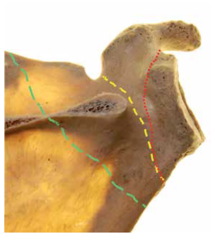 Fractures of scapular neck. Right scapula, posterior
view, with scapular spine resected. Anatomical neck fracture
– red, surgical neck fracture – yellow, transspinous
neck fracture – green.