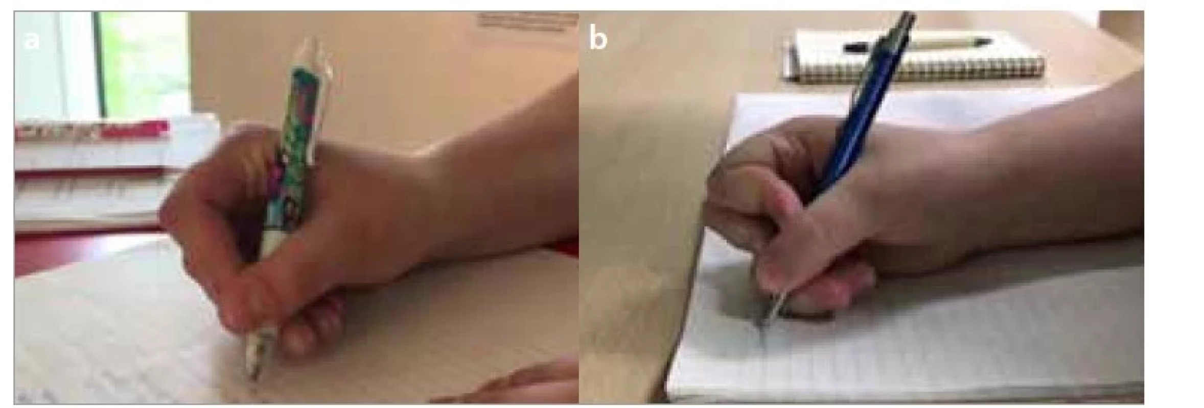 a,b. Boční palcový úchop – a) tříprstý, b) čtyřprstý.<br>
Fig. 4a,b. Lateral thumb grip – a) lateral tripod grip, b) lateral quadruped grip.