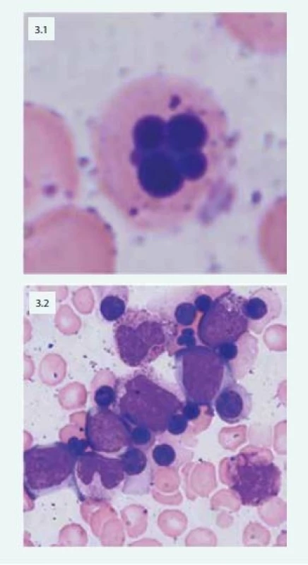 Mnohojaderný erytroblast u pacientky s CDA
(3.1) Patologické multinukleární erytroblasty
typické u pacientů s CDA IV (3.2)