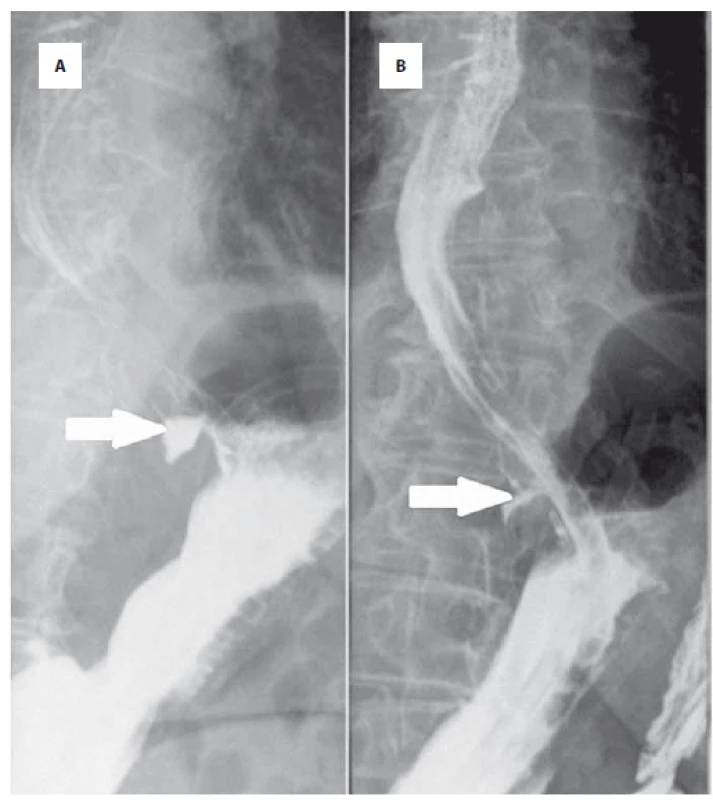 76-ročný pacient s periprocedurálnou perforáciou v oblasti fundu žalúdka,
ošetrenou endoskopicky klipmi A – RTG pasáž verografínom po 24 hod
zobrazuje intramurálny únik kontrastnej látky (šípka); B – kontrolná RTG pasáž
po 5 dňoch zobrazuje redukciu úniku kontrastnej látky intramurálne (šípka).<br>
Fig. 1. 76-year-old patient with periprocedural perforation in the fundus of the stomach,
endoscopically treated with clips A – X-ray passage with verografin after
24 hours shows intramural leakage of contrast medium (arrow); B – control X-ray
passage after 5 days shows reduction of intramural contrast medium (arrow).