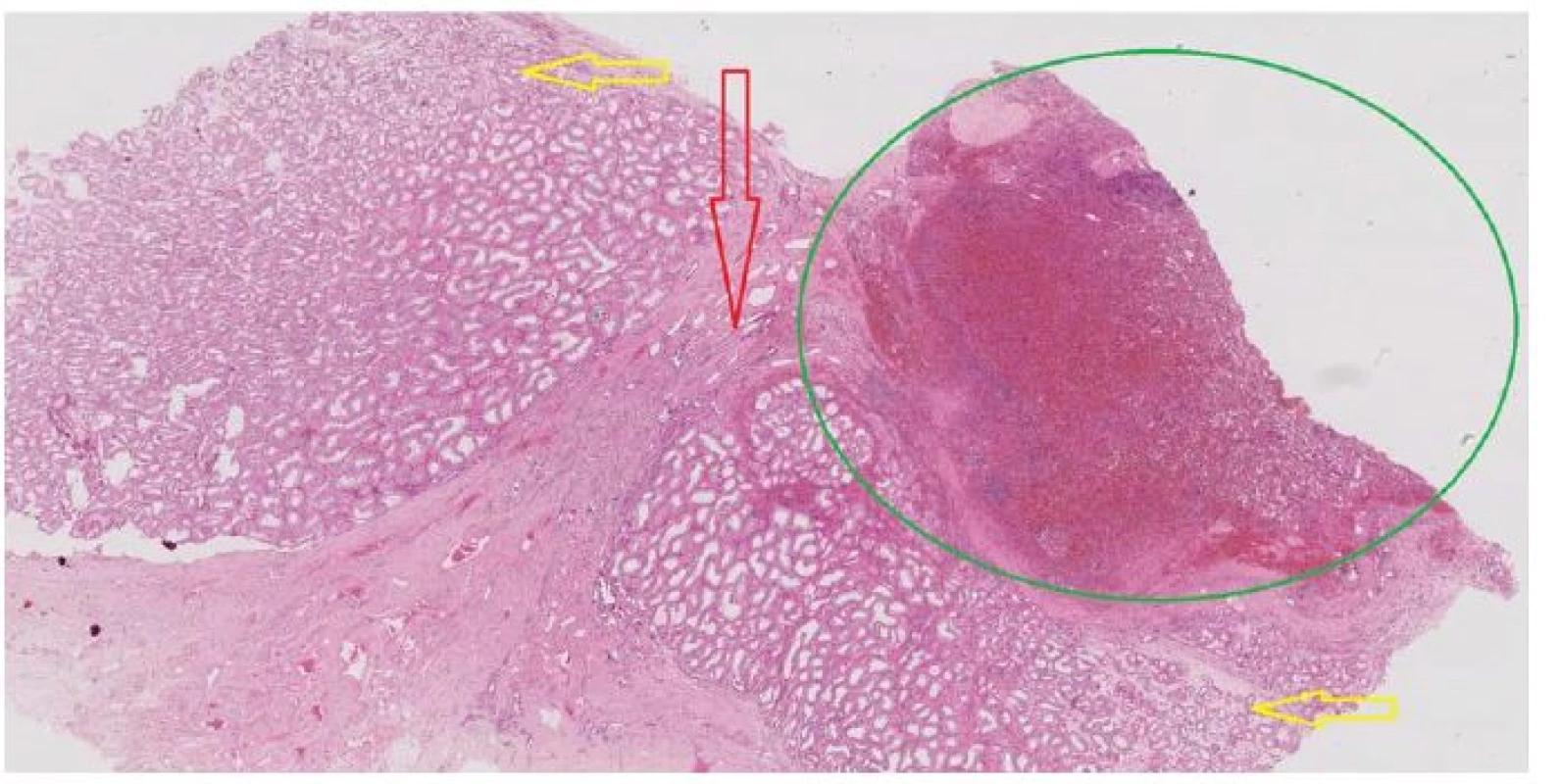 Histologický preparát: zelenou je označena tkáň sleziny, červená šipka směřuje k rete testis, žluté šipky
označují parenchym varlete (se semenotvornými kanálky), zvětšeno 100x, barvení H&E<br>
Fig. 2. Histological specimen: the splenic tissue is marked green, the red arrow points to the rete test