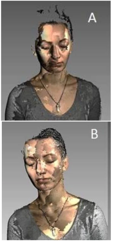 Hair Scanning, A) Without water application, B) After water application.