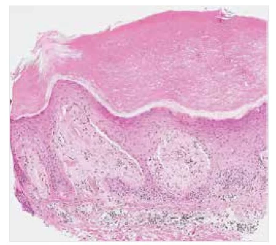 Lichen amyloidosus – histopatologie<br>
Barvení HE, původní zvětšení 100krát.