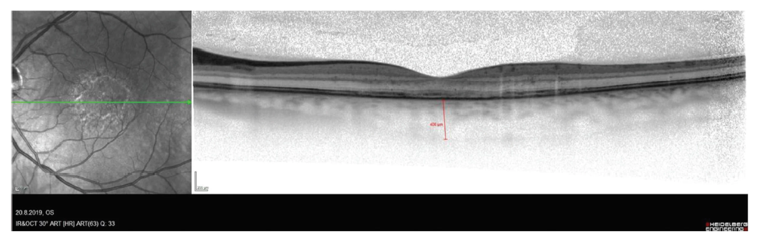Snímek optické koherenční tomografie pacienta s chorioretinitidou se snížením reflexivity vrstvy retinálního pigmentového
epitelu a zesílení cévnatky