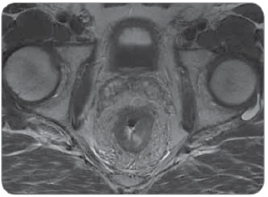  „Bad“ tumor u mužského pacienta,
nádor v 5 cm infi ltrující mezorektální tuk
s těsným vztahem k fascia recti a semenným váčkům.
