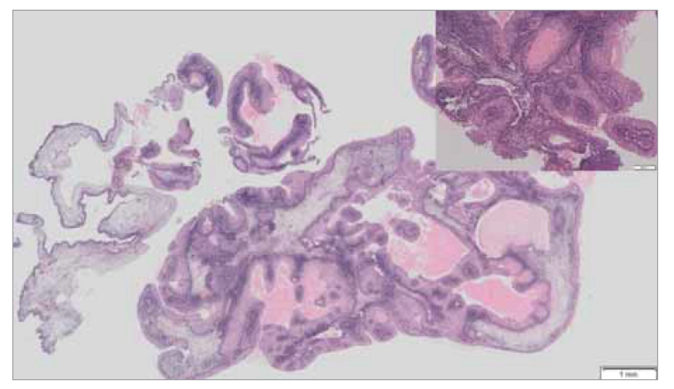 Histologické vyšetření, barvení hematoxylin-eozin, zvětšení 4x, papilárně
utvářený tumor s exofytickým a endofytickým (invertovaným) typem
růstu tvořený dlaždicovým epitelem s dyskeratózou, s ojedinělými mucinózními
buňkami, s reaktivními změnami epitelu, vazivové stroma je prostoupeno
zánětlivou celulizací.<br>
Fig. 4. Histological examination, hematoxylin-eosin staining, magnification 4x,
papillary tumor with exophytic and endophytic (inverted) growth type consisting
of squamous epithelium with dyskeratosis, with isolated mucinous cells, with reactive
epithelial changes, fibrous stroma is permeated by inflammation.