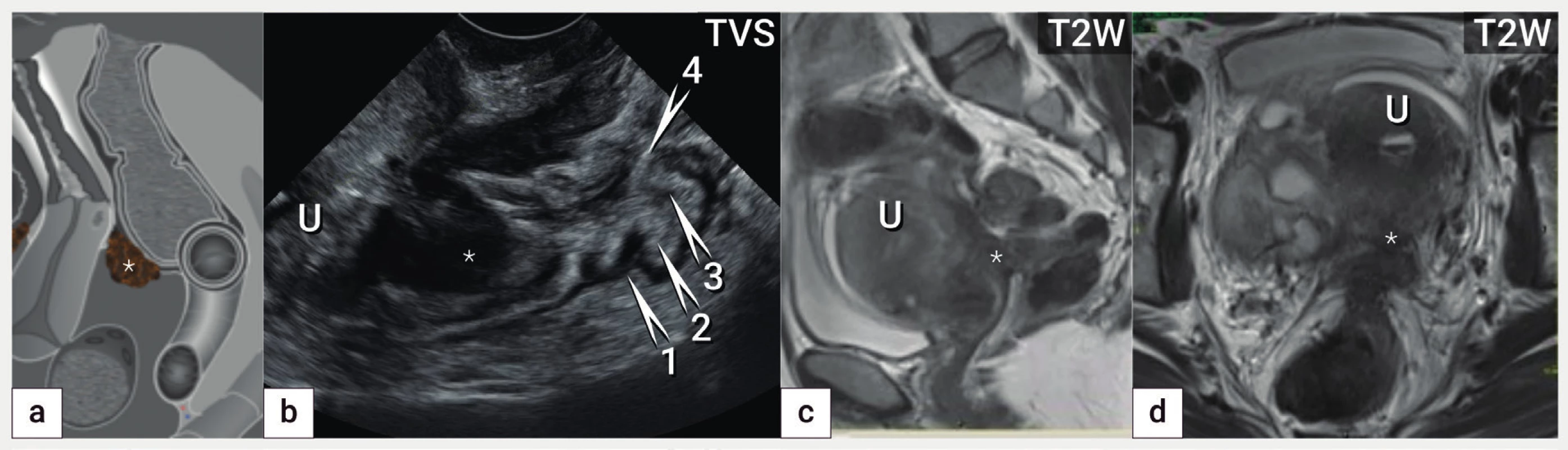 Anatomie rekta a rektosigmoidea: hluboká endometrióza horního rekta<br>
Schéma hluboké endometriózy horního rekta (označena hvězdičkou) (a), ultrazvukový nález hluboké endometriózy přední stěny horního rekta
s hypoechogenní infiltrací svalové vrstvy (muscularis propria) a submukózy (hvězdička) (b), magnetická rezonance v T2 váženém obrazu
v sagitálním (c) a transverzálním řezu (d) s nálezem identické léze DE (hvězdička). Označení vrstev zadní stěny rekta od serózy k mukóze
(1 – muscularis propria, 2 – submukóza, 3 – muscularis mucosae, 4 – mukóza). U – uterus. TVS – transvaginální sonografie, T2W – T2 vážené
obrazy v magnetické rezonanci.