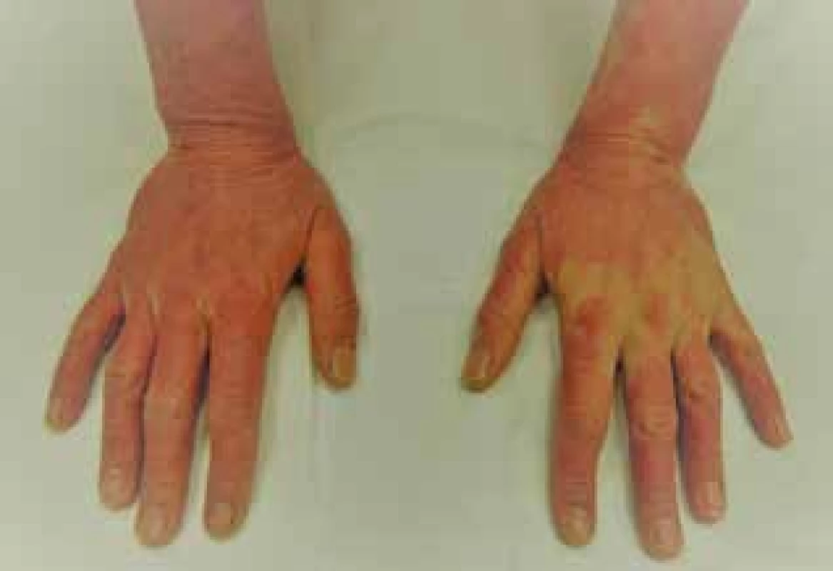 Eczema contactum allergicum manum (tiskárna – UV
tvrzené akrylátové barvy)