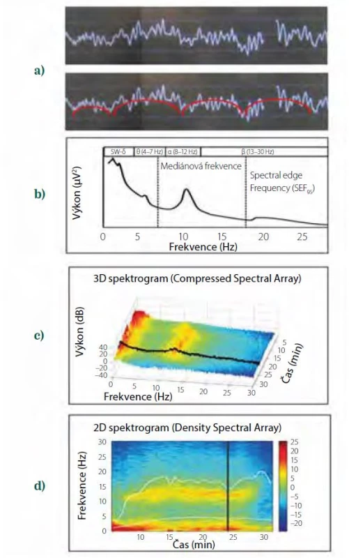 Transformace syrové EEG křivky do dvourozměrného spektrogramu.
a) syrová EEG křivka v jedné epoše, b) zjednodušené schéma Fourierovy
transformace syrové EEG křivky na dvě sinusoidy, červená s pomalou frekvencí,
bílá s rychlejší frekvencí, c) výkonové spektrum epochy, vyznačena
mediánová frekvence a frekvence spektrálního okraje (SEF95), tj. frekvence,
pod nimiž je 50 %, resp. 95 % výkonu, d) trojrozměrný spektrogram, v němž
jsou jednotlivá výkonová spektra řazena v čase odzadu dopředu, výkon (dB)
je na ose y a současně je vyznačen barevně, e) dvourozměrný spektrogram,
v němž je čas na ose x, frekvence na ose y a výkon (dB) kódován barevně