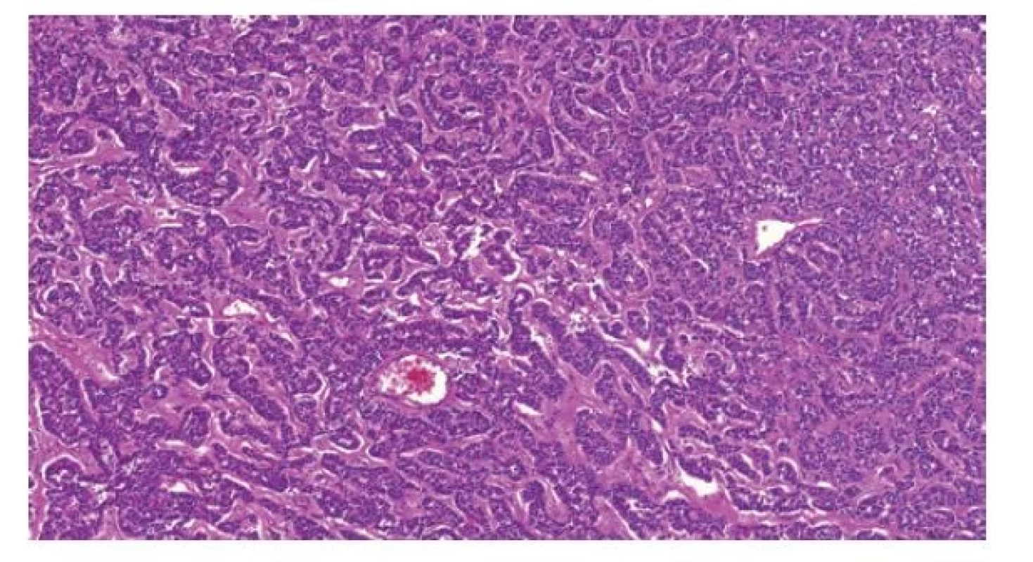 Testikulární neuroendokrinní tumor prepubertálního typu je histologicky
identický neuroendokrinním tumorům gastrointestinálního traktu.