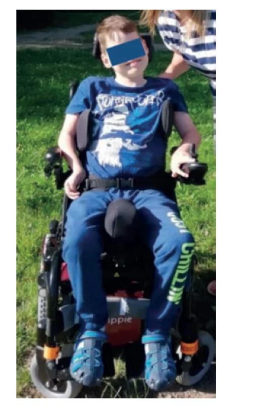 Chlapec ve věku 8 let na elektrickém vozíku. Objektivně patrná lehká
faciální stigmatizace, dystrofický habitus, četné kontraktury horních i dolních
končetin.