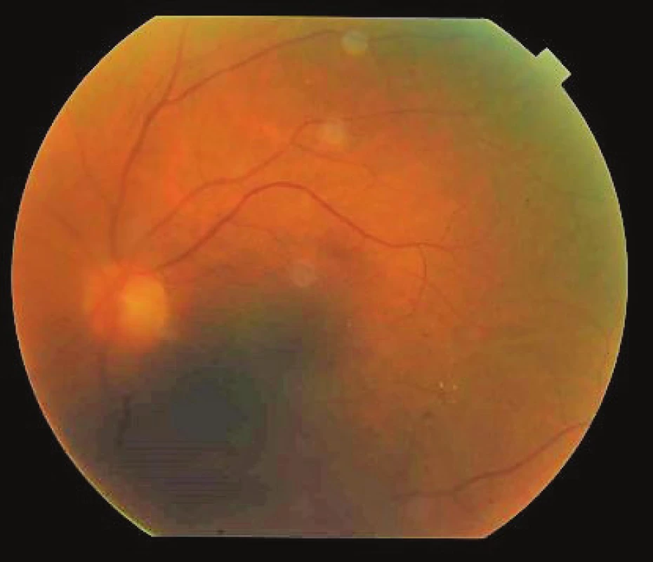 Finding on ocular fundus of left eye 8 weeks after
commencement of therapy, minimal exudation in vitreous
body