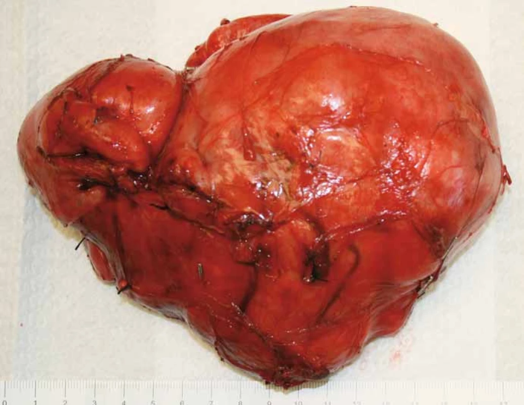 Stav po resekci tumoru se zachováním pravé ledviny, vena cava inferior byla v celém infrarenálním průběhu odpreparována od tumoru, byly přerušeny přímé spojky jdoucí z tumoru do zadní stěny dolní duté žíly a zresekována retroaortální porce nádoru.