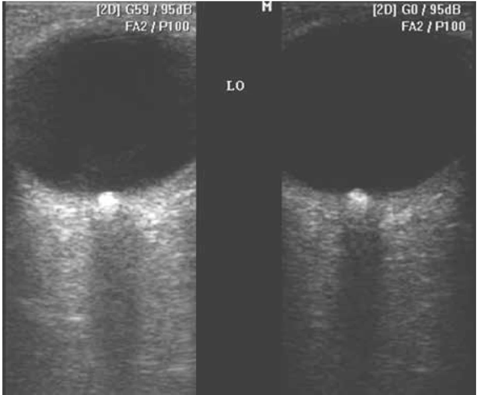 Vľavo: Drúzy optického nervu B-scan ultrasonografie v štandardnom
móde - gain 59 dB. Vpravo: “halo” efekt drúz optického nervu je minimalizovaný
(drúzy sa zobrazia v skutočnej veľkosti), ak gain znížime na 0 dB