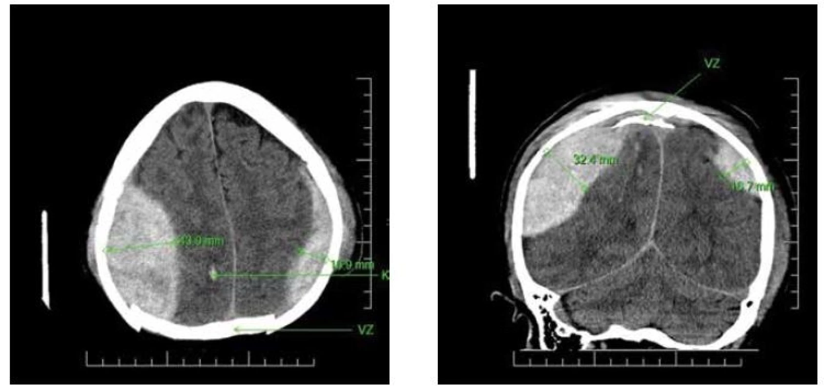 AB: Nativní CT snímek, axiální a koronární řez
EDH bilaterálně spolu s vpáčenou zlomeninou, která je umístěna nad horním sagitálním splavem. (K = kontuze, VZ = vpáčená
zlomenina)<br>
Fig. 2AB: CT images of a patient’s brain demonstrating bilateral EDH on axial and coronal image
The scan shows depressed fracture above the sagittal superior sinus. (K = contusion, VZ = depressed fracture)