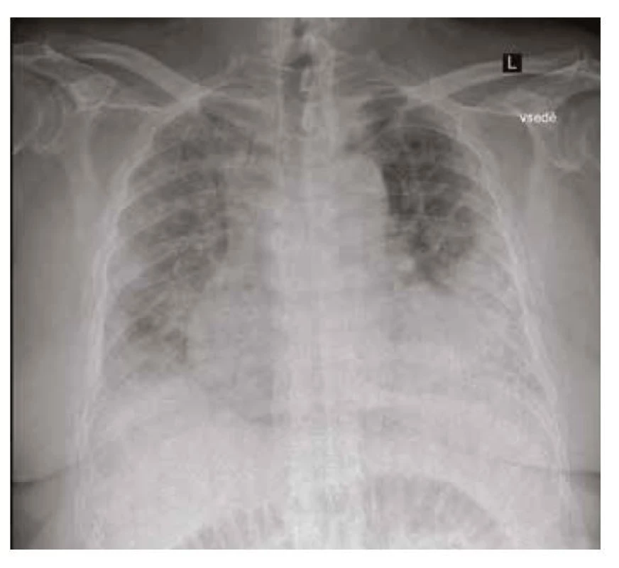 RTG plic při přijetí v 72020 – recidiva bilaterálního zastínění v kombinaci
s bilaterálních fluidothoraxem