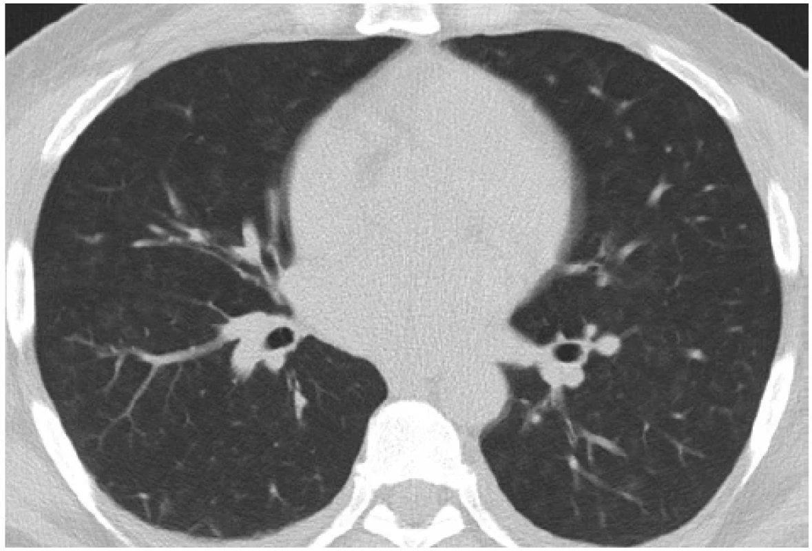 CT hrudníku – bilaterálně difuzní centrilobulární denzity mléčného skla, transverzální řez – úroveň Th7 (se svolením Kliniky radiologie a nukleární medicíny, FN Brno, MUDr. R. Bárta)