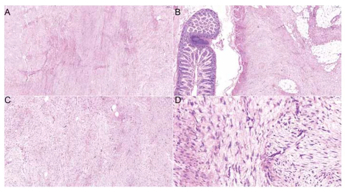 Histologické preparáty zachycující fibroblastickou/myofibroblastickou vřetenobuněčnou proliferaci vykazující
fascikulární stavbu z dlouhých buněčných svazků tzv. long sweeping fascicles, kapiláry sledují směr svazků (A: hematoxylin
eosin, 5x). Léze vykazuje infiltrativní okraje a vrůstá do hladkosvalové stěny tenkého střeva a tukové tkáně mezenteria
(B: hematoxylin eosin, 5x). Léze vykazuje nízkou buněčnost, sestává ze štíhlých vřetenitých buněk charakteru (myo)fibroblastů
(C: hematoxylin eosin, 10x). Některé buňky tvarově kopírují zvlněná kolagenní vlákna, bez cytonukleárních atypií
(D: hematoxylin, 20x).<br>
Fig. 2. Histology slides showcasing fibroblastic/myofibroblastic spindle cell proliferation exhibiting fascicular structure formed
by long cell bundles, so-called long sweeping fascicles, and capillaries following the direction of the bundles (A: hematoxylin
eosin, 5x). The tumour exhibits marginal infiltration of the small intestine smooth muscle wall and adjacent adipose mesentery tissue
(B: hematoxylin-eosin, 5x). The tumor is of low cellularity, consisting of (myo) fibroblasts (C: hematoxylin-eosin, 10x). Some cells
copy the wavy shape of collagen fibers, showing no nuclear atypia (D: hematoxylin, 20x).