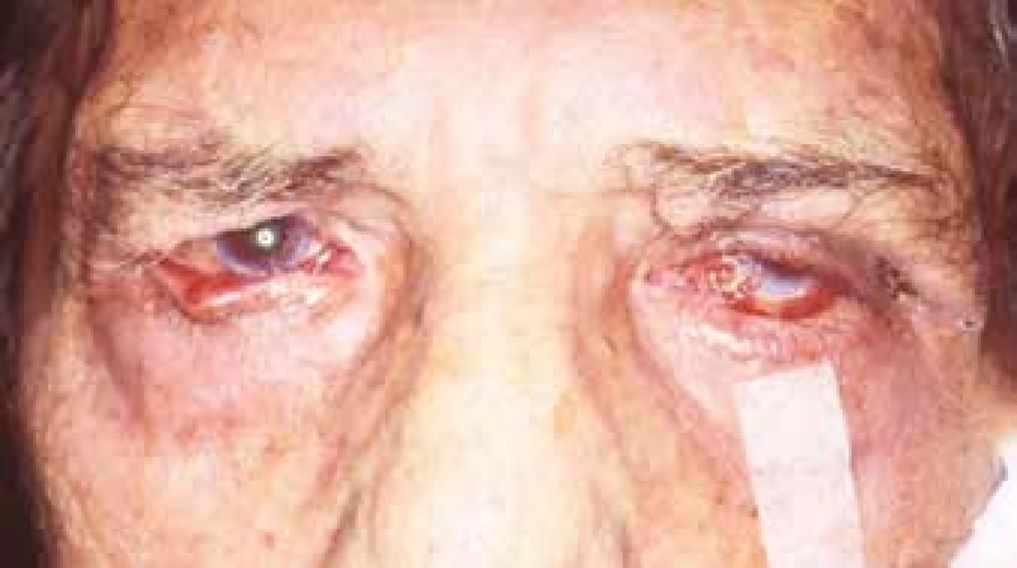Change of position of eyelids as a consequence of granulomatous
inflammation of the eyelids and conjunctivas