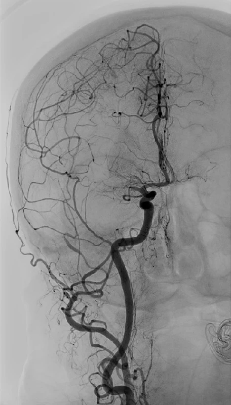 Angiografie provedená na počátku mechanické trombektomie u stejného pacienta